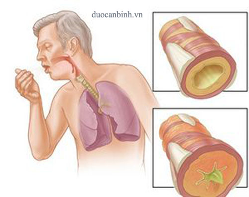 Cách trị ho hiệu quả